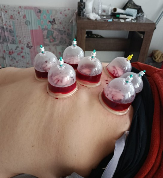 Elazığ’da Merdiven Altı Hacamat Skandalı: Migren İçin Gitti, 50 Bin TL’sini Kaybetti